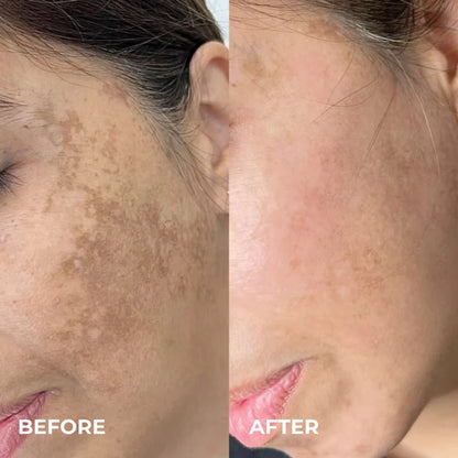 Silvryne™ Alpha Arbutin + TXA Dark Spot Cream
