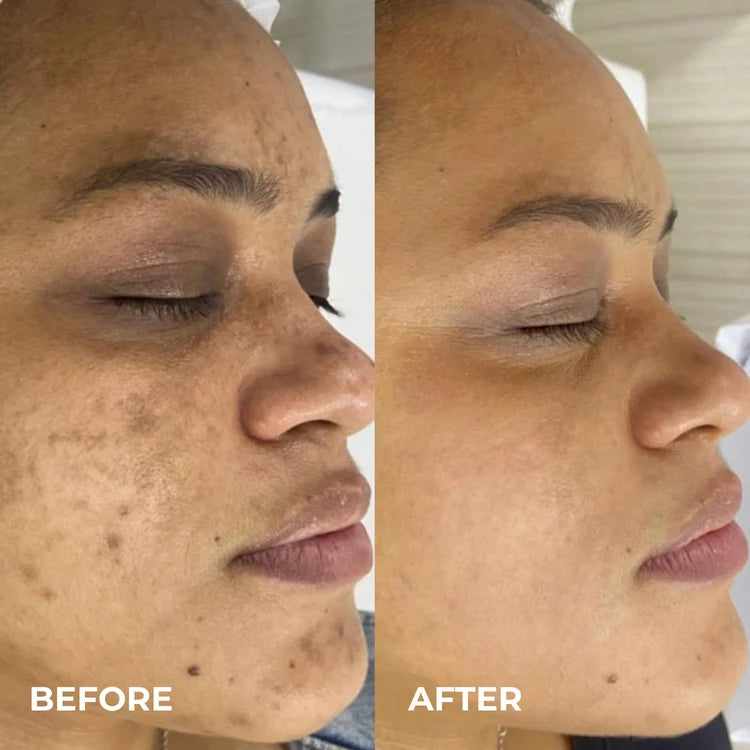 Silvryne™ Alpha Arbutin + TXA Dark Spot Cream