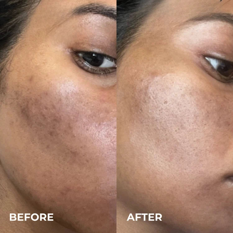 Silvryne™ Alpha Arbutin + TXA Dark Spot Cream