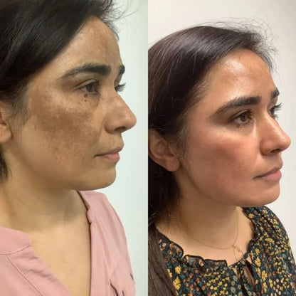 Silvryne™ Alpha Arbutin + TXA Dark Spot Cream